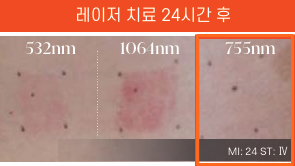 제주 여드름흉터 치료 | 피코프락셀 효과, 딱지·붉은기 부담된다면